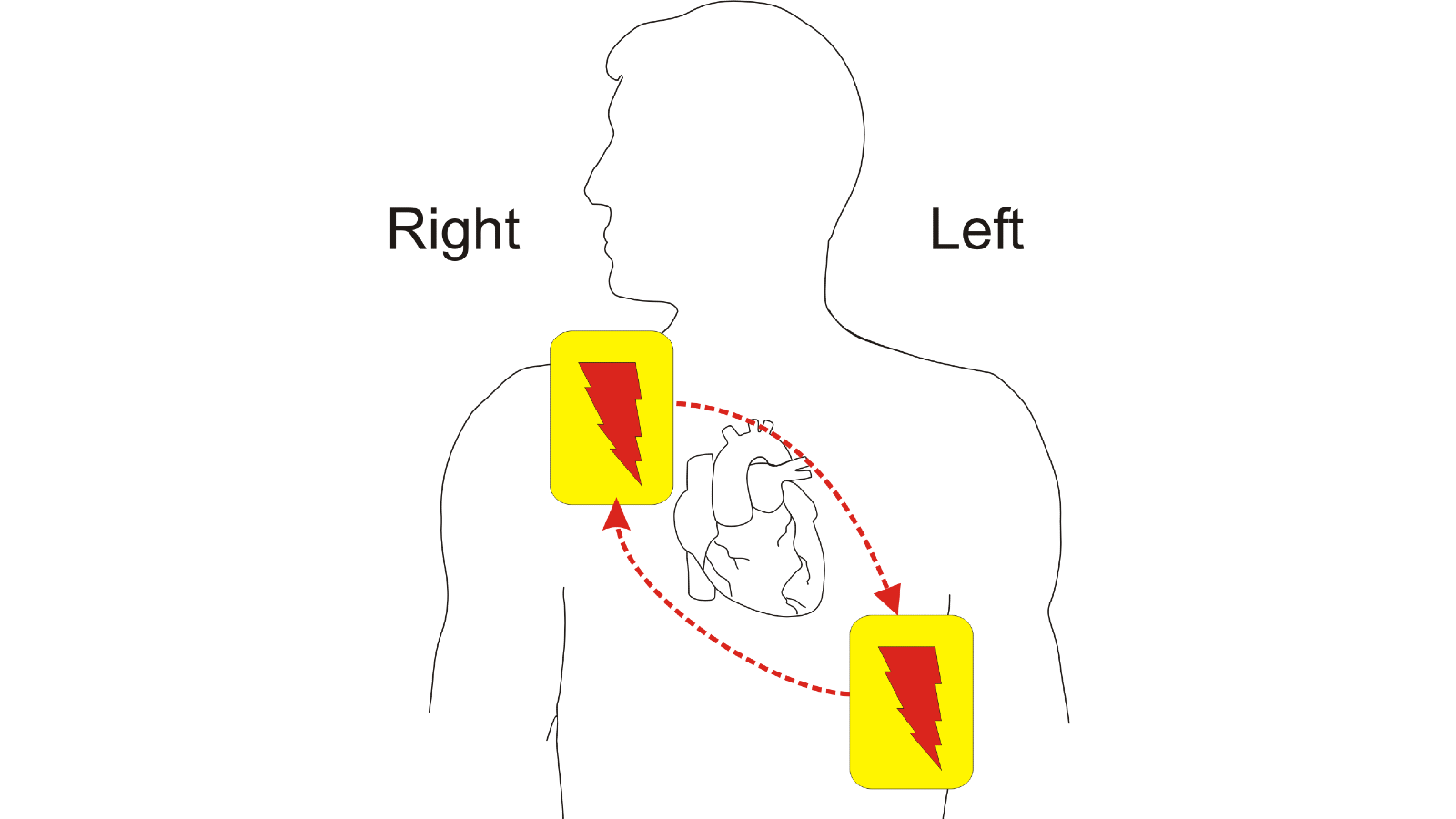 Diagram showing correct placement of AED pads for optimum shock through axis of heart